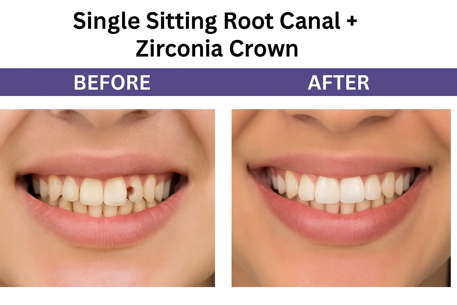 Smile Makeover – Ceramic Braces